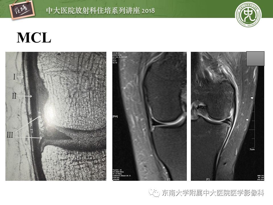 精彩推荐 | 膝关节的正常MR解剖及常见变异